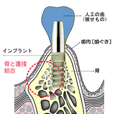 インプラント